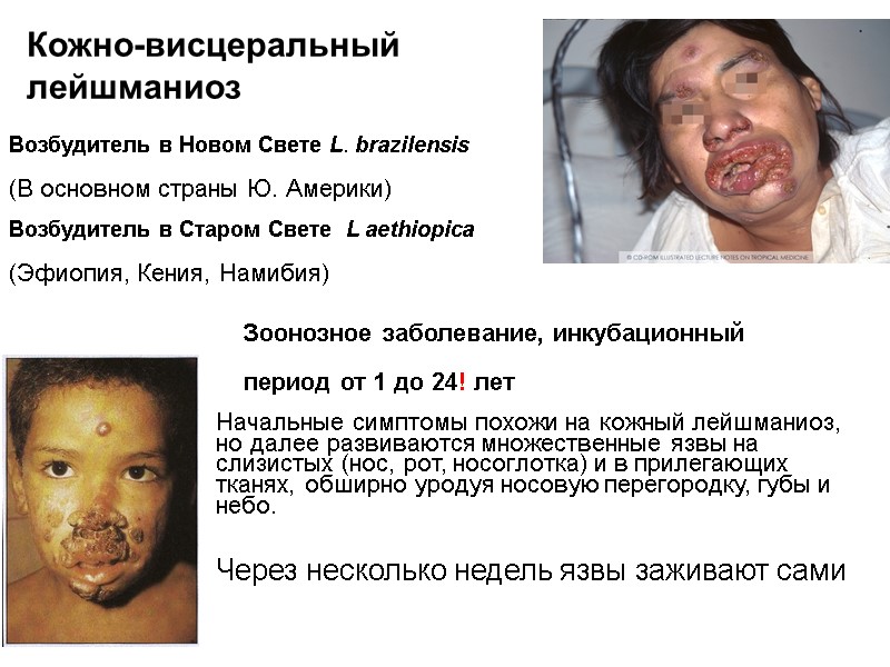 Кожно-висцеральный лейшманиоз Возбудитель в Новом Свете L. brazilensis  (В основном страны Ю. Америки)